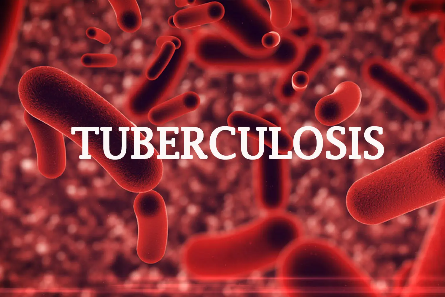 Tuberculosis